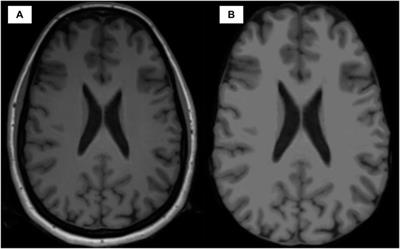 Classification of multiple sclerosis clinical profiles using machine learning and grey matter connectome